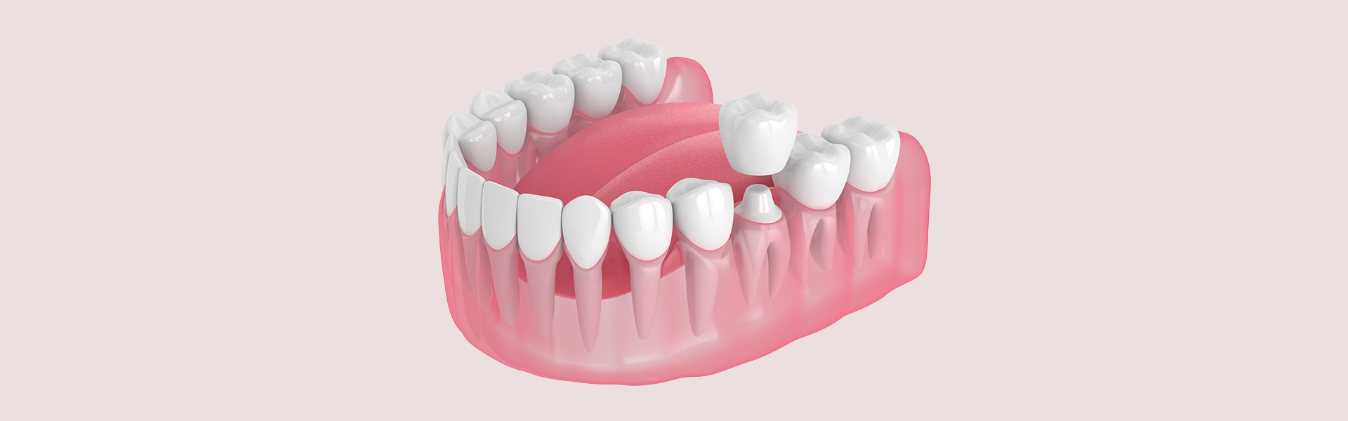 8 Things You Need to Know About Dental Crowns