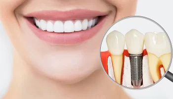 7 Long-Term Smile Benefits of Successful Dental Implants