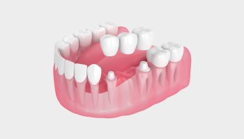 How to Care for Your Dental Bridge for Long-Lasting Results