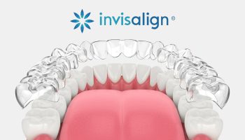 Invisalign Treatment Timeline: What Patients Can Expect Month by Month