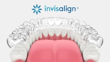 Invisalign Treatment Timeline: What Patients Can Expect Month by Month